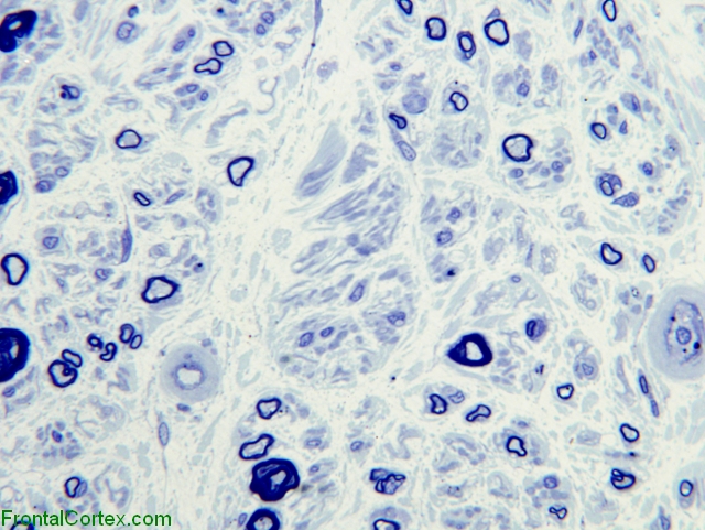 Diabetic neuropathy,Sural nerve, toluidine bluex600